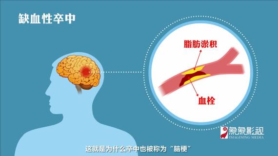 卒中医疗二维动画