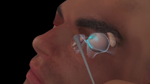 3D 动画滴眼液