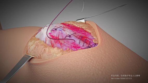 骨科动画缝线的用法