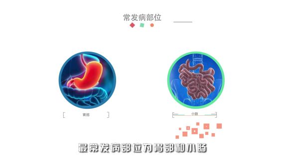 MG医疗动画-胃肠间质瘤短片
