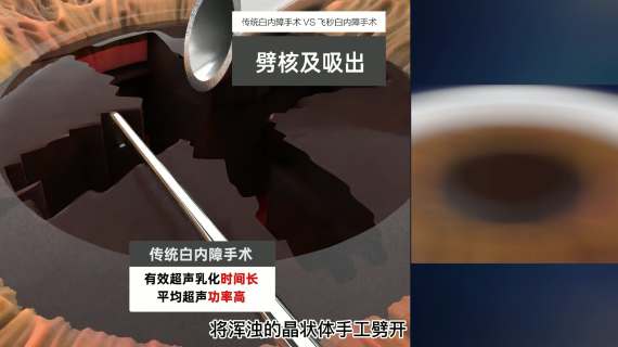 飞秒白内障手术与传统白内障手术对比动画