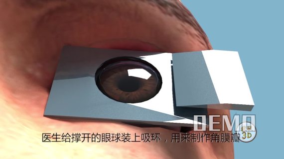 3D动画飞秒近视手术