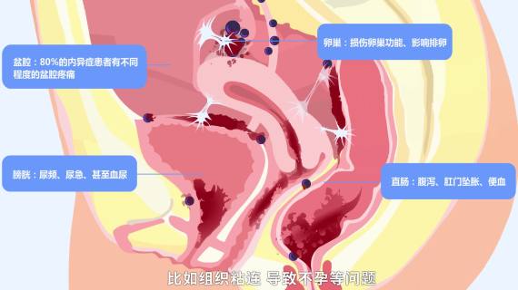 内异症现状