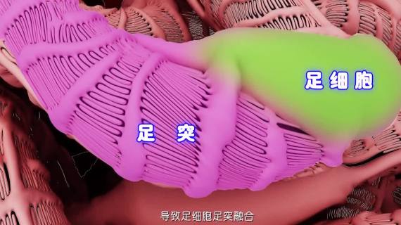 局灶节段性肾小球硬化