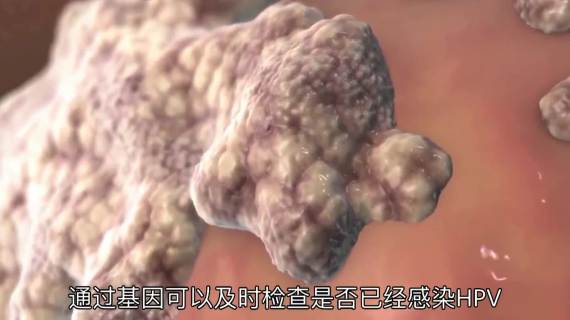 宫颈癌