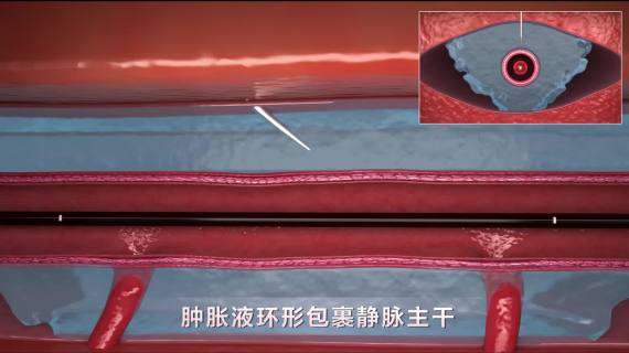 静脉曲张射频消融手术三维动画