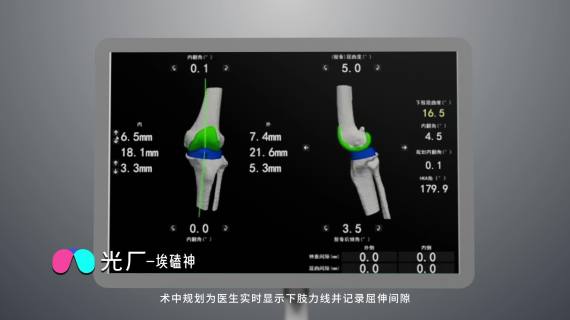 膝关节置换手术机器人
